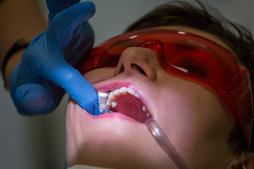 Getting braces on teeth
