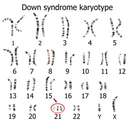 Down syndrome karyotype