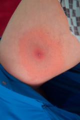 Lyme disease