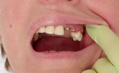 Dental, closeup of broken artificial tooth and dentist hand