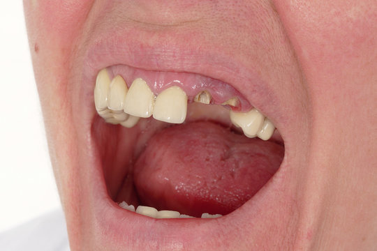 Dental, closeup of broken artificial tooth