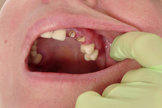 Dental, closeup of broken artificial teeth and dentist hand