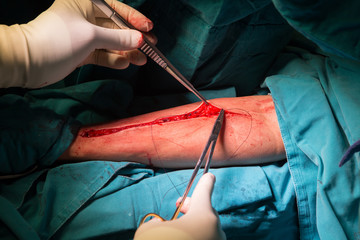 closure sternum bone with metal wires