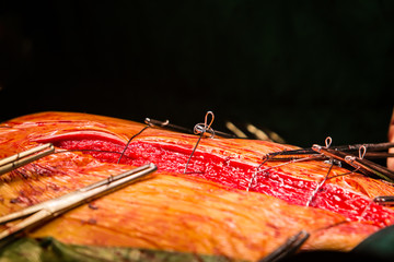 closure sternum bone with metal wires