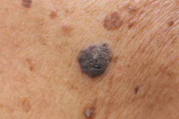suspicious mole on skin