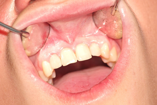 Teeth of the upper jaw after treatment