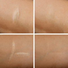 Removal of scars on the skin - obrazy, fototapety, plakaty
