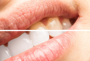 Woman Teeth Before And After Dentist Clinic Whitening Procedure