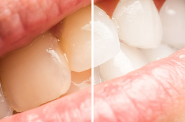 Fototapeta premium Woman Teeth Before And After Dentist Clinic Whitening Procedure