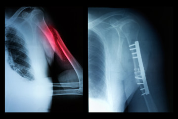 Broken bone before and after surgical intervention