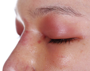 close-up of upper eye lid swell after nose job