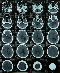X-ray image of the brain computed tomography