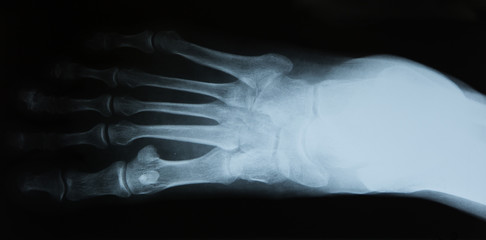 human foot ankel and leg xray picture