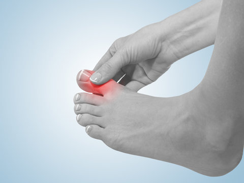 Painful and inflamed foot around the big toe area.