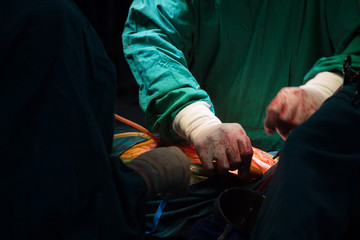 Surgery for Coronary Artery Bypass