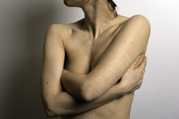 Women body with birthmarks