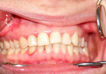 Malocclusion. Curvature of the upper dentition