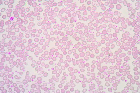 A blood smear is often used as a follow-up test to abnormal resu