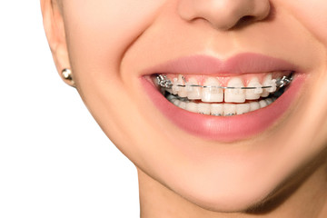 Ceramic Dental Braces Teeth Female Smile