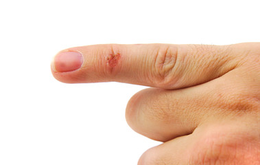 Wound on baby or pinky finger isolated on a white background