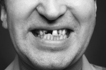 Obraz premium Bad teeth smoker