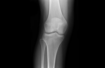 Xray Knee Joints of an Adolescent