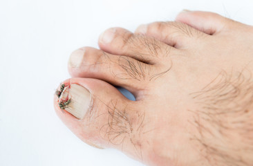 Obraz premium Broken toenail on white background