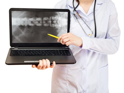 nurse points on computer laptop with spinal column