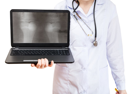 nurse holds computer laptop with human knee joint