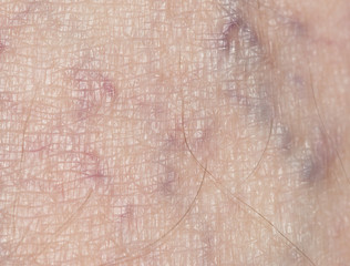 Fototapeta premium varicose veins in the leg