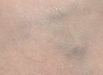 Fototapeta premium varicose veins in the leg