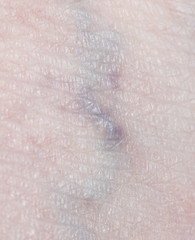 varicose veins in the leg