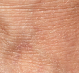 varicose veins in the leg