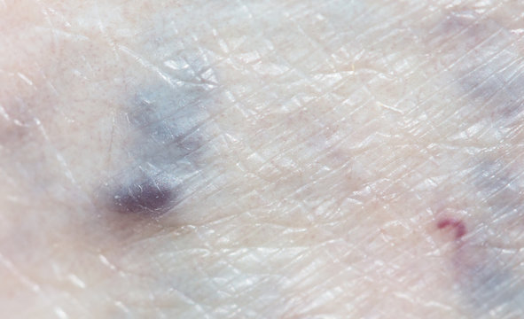 varicose veins in the leg