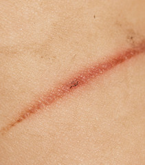 Fototapeta premium burn on hand