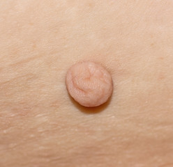 skin papilloma