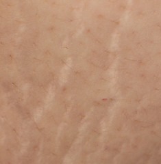 stretch marks on the abdomen as background