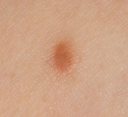 small scar on his leg