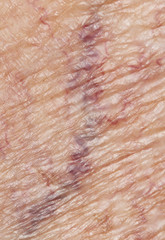 .veins on the skin