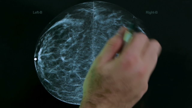 Mammogram X Ray Analysis