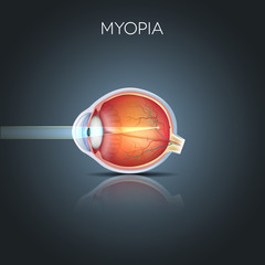 Myopia. Myopia is being short sighted (near sighted). Far away o
