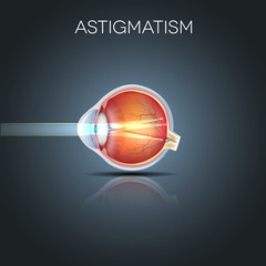 Astigmatism. Eyesight problem, blurred vission. - obrazy, fototapety, plakaty