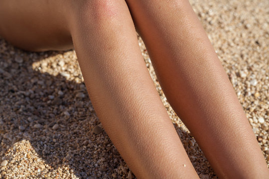 Horripilation from the cold on the legs