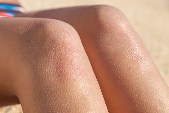Horripilation from the cold on the legs