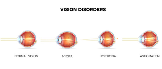 Eyesight disorders. Normal eye, Astigmatism, hyperopia and myopi - obrazy, fototapety, plakaty