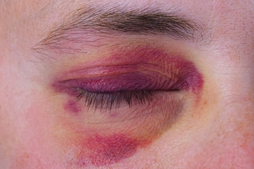 Human eye with a purple bruise