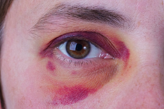 Human eye with a large bruise