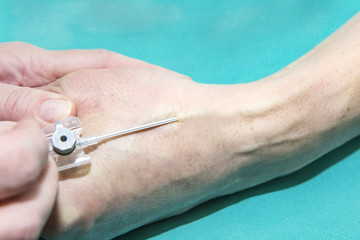 Peripheral vein catheterisation for intravenous drug infussion