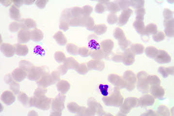 malaria blood smear pictures