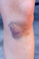 Hematoma